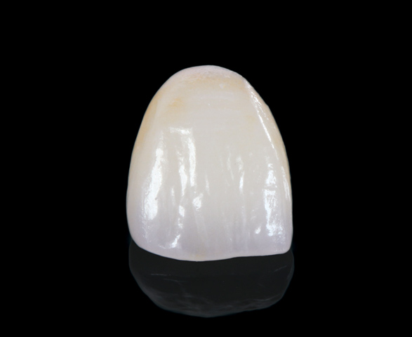 EMAX ANTERIORS (CROWN/BRIDGE)